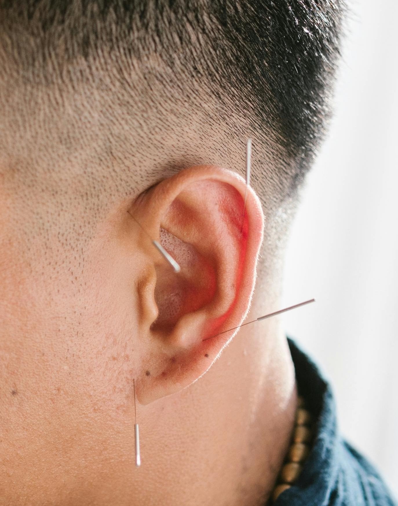 Ear acupuncture photo