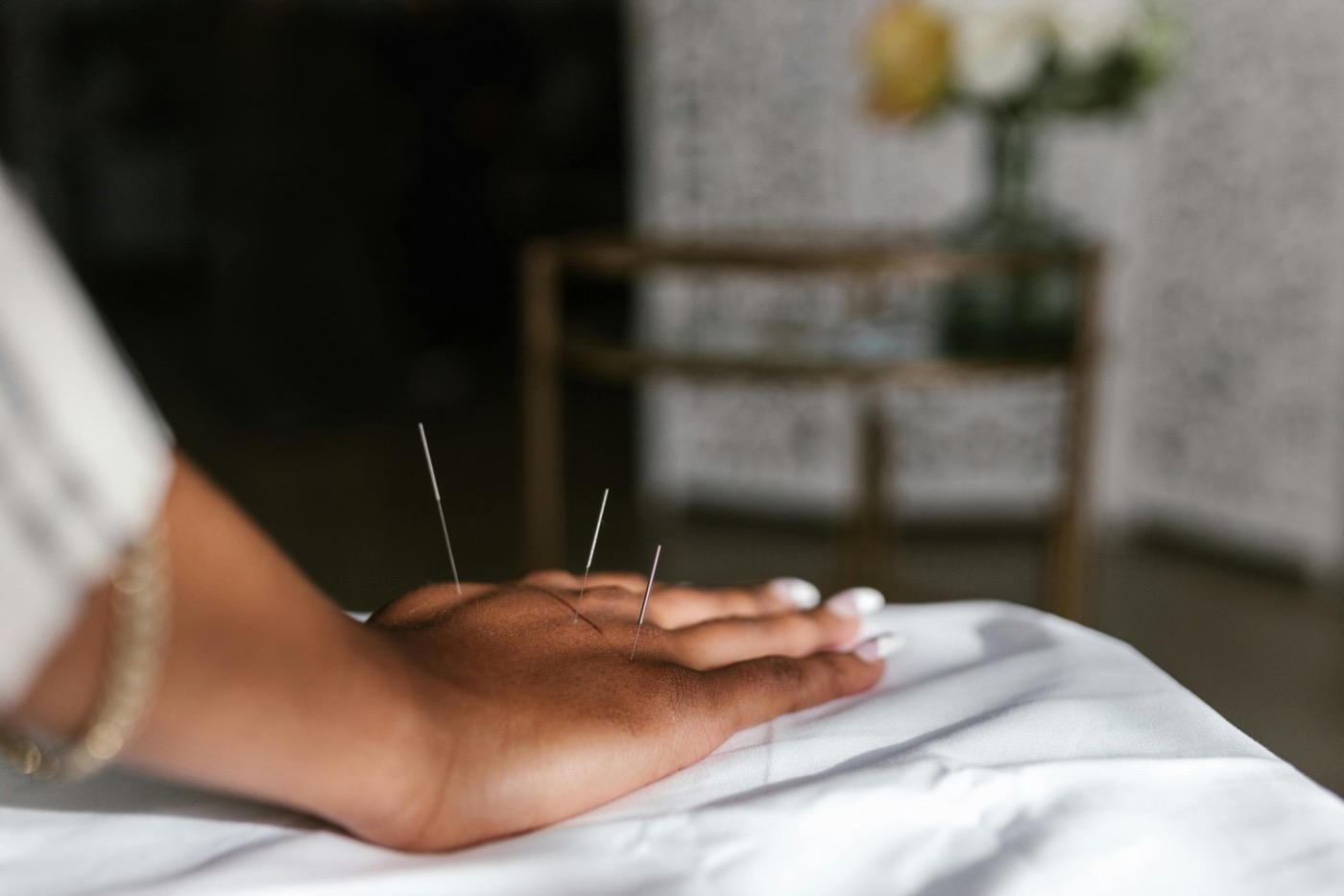 Acupuncture hand photo