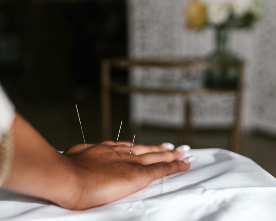 Acupuncture close-up