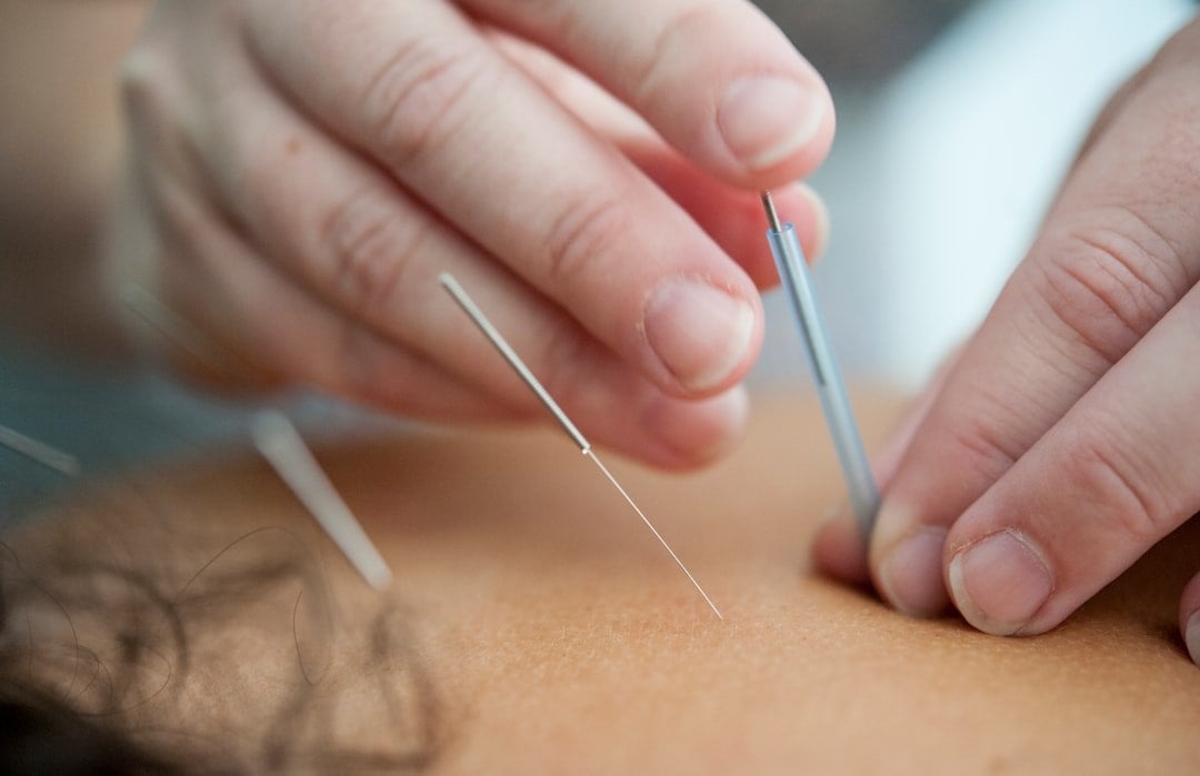 Acupuncture session